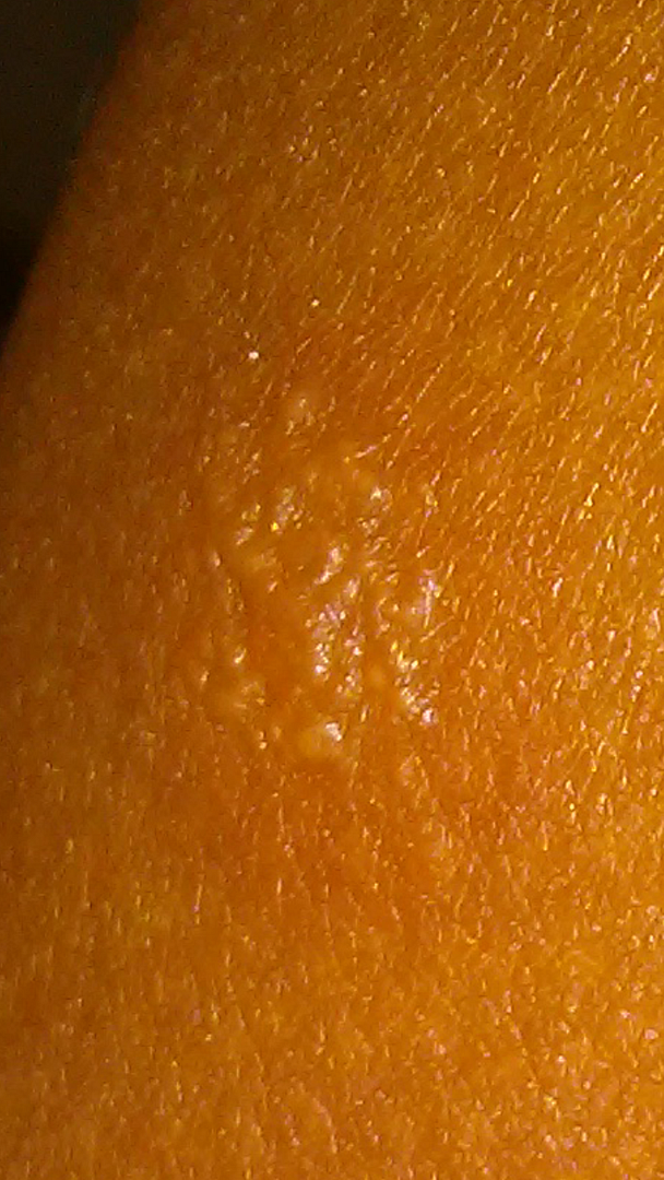 Herpes Forum Support Group Online for HSV